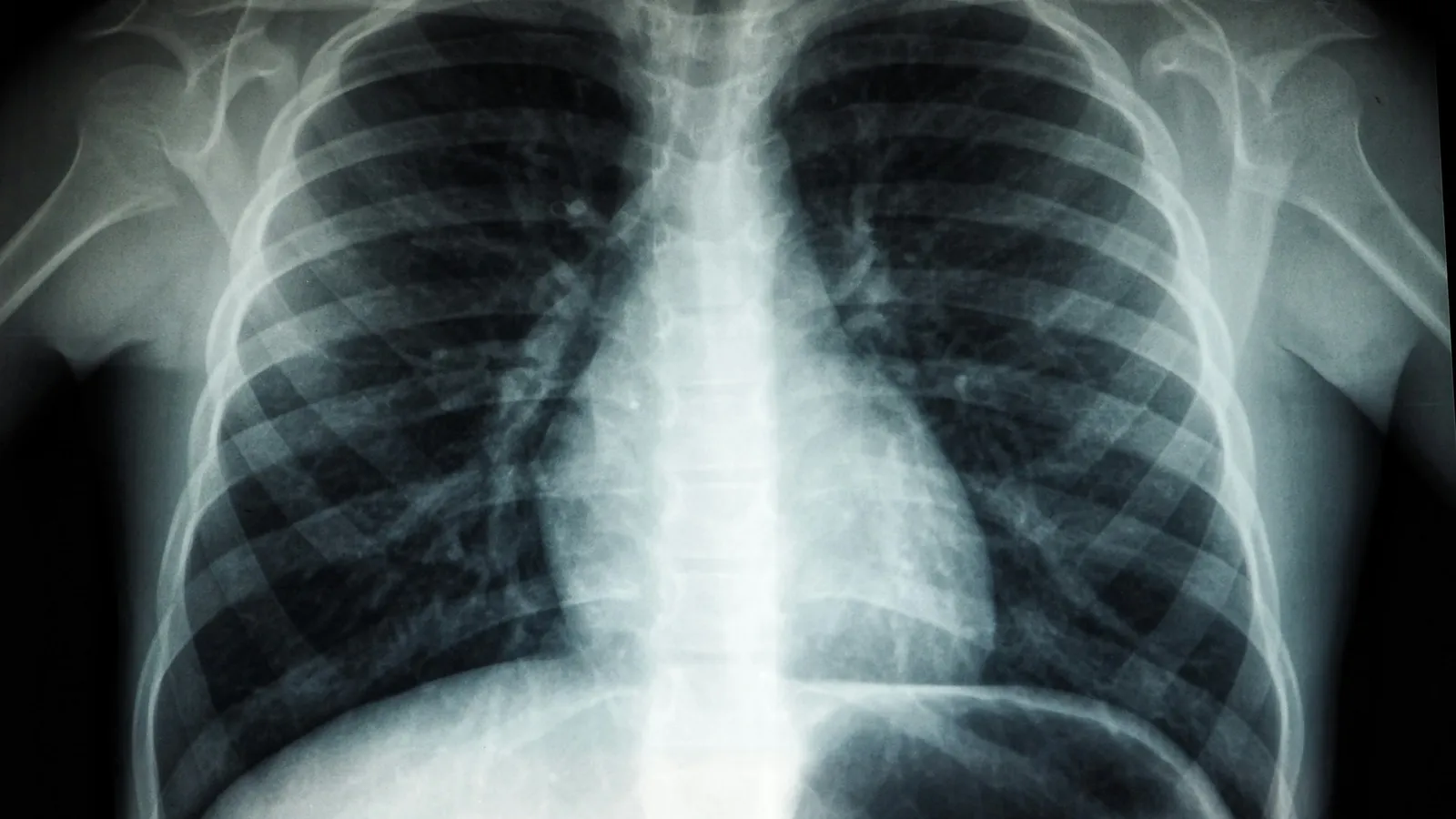 A chest X-ray image on a dark background