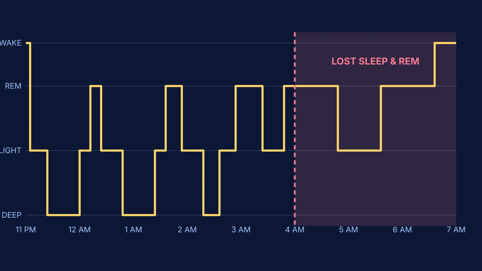 A hypnogram showing a sleep cycle interrupted at 4 AM, losing REM sleep