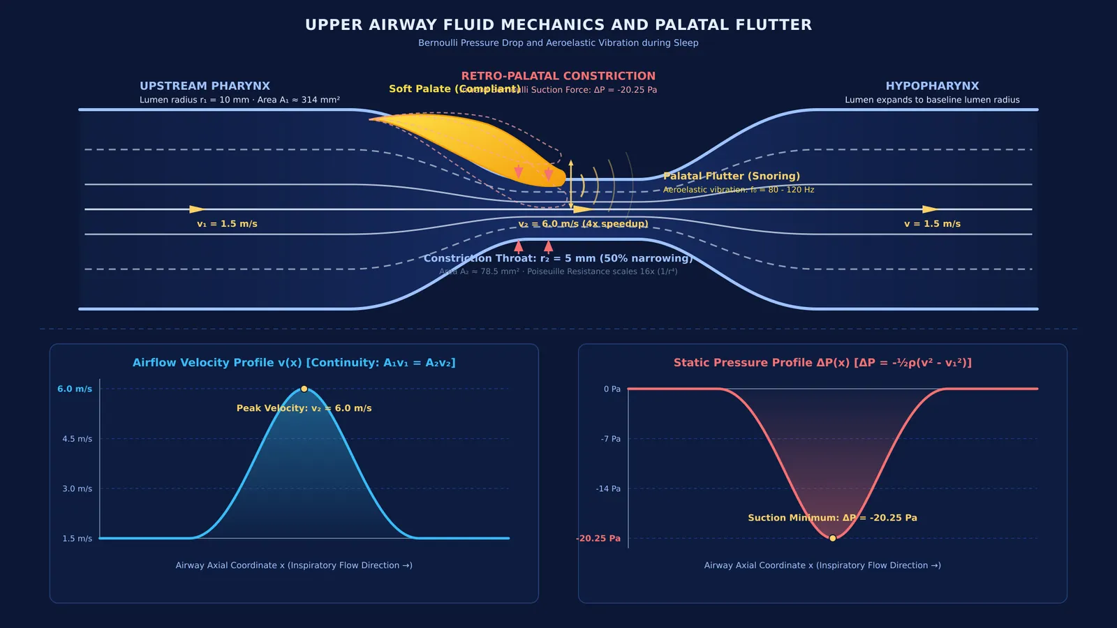Airway constriction diagram showing Bernoulli pressure drop and fluttering soft palate producing sound waves