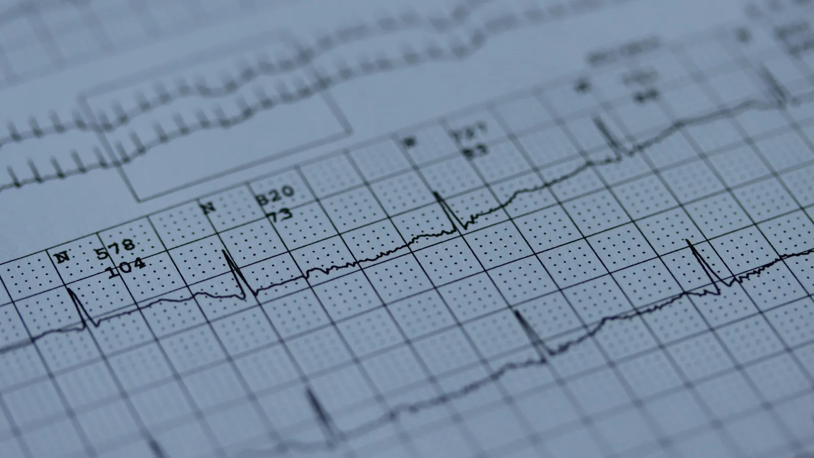 An ECG trace printed on grid paper