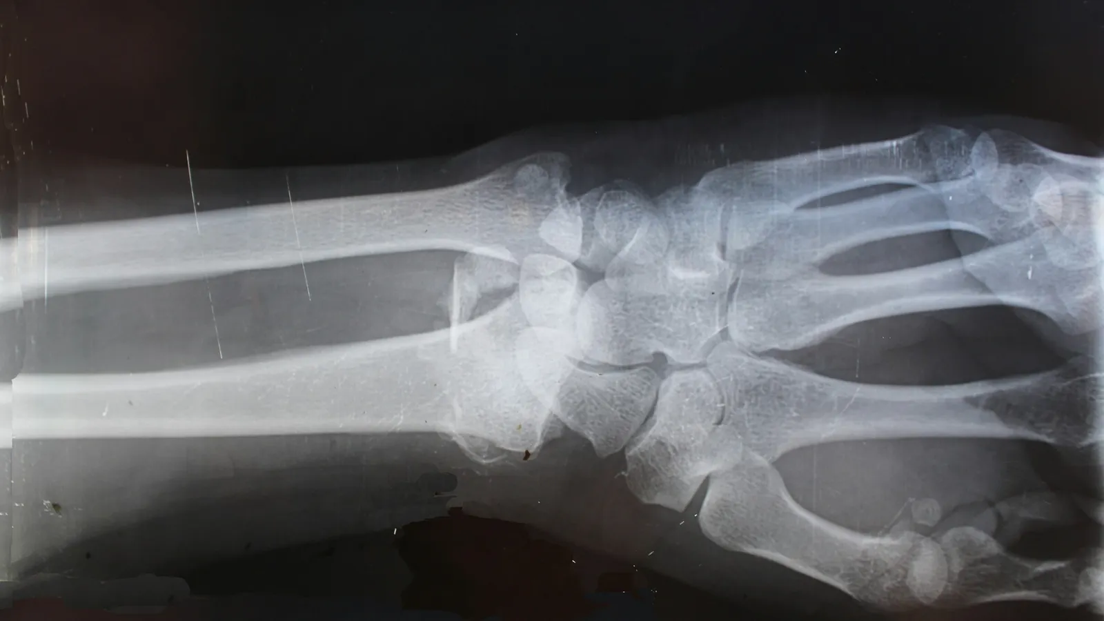 An X-ray image of the bones of a human hand and wrist