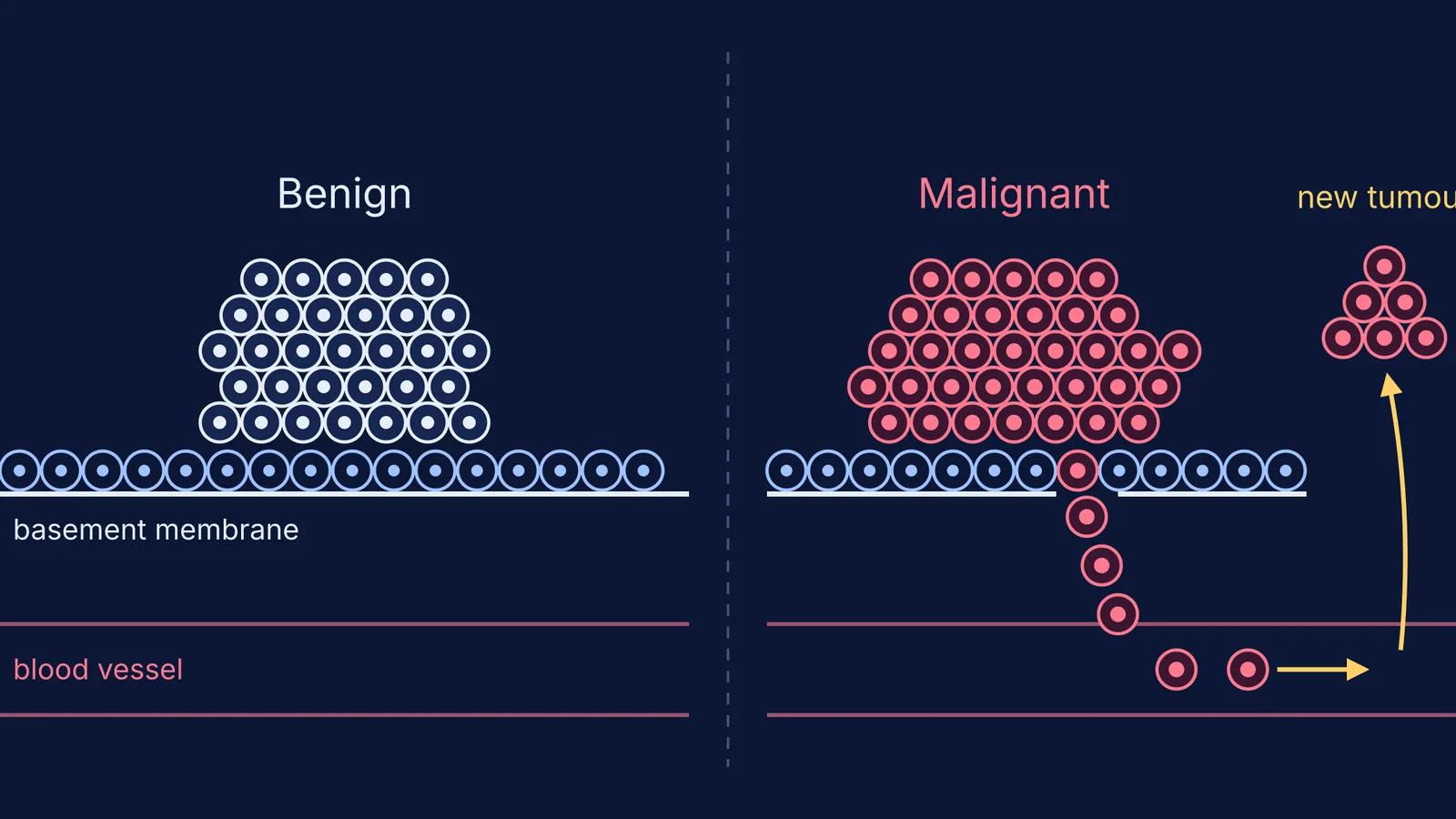 Benign cell mass staying above a membrane beside malignant cells spreading through a blood vessel