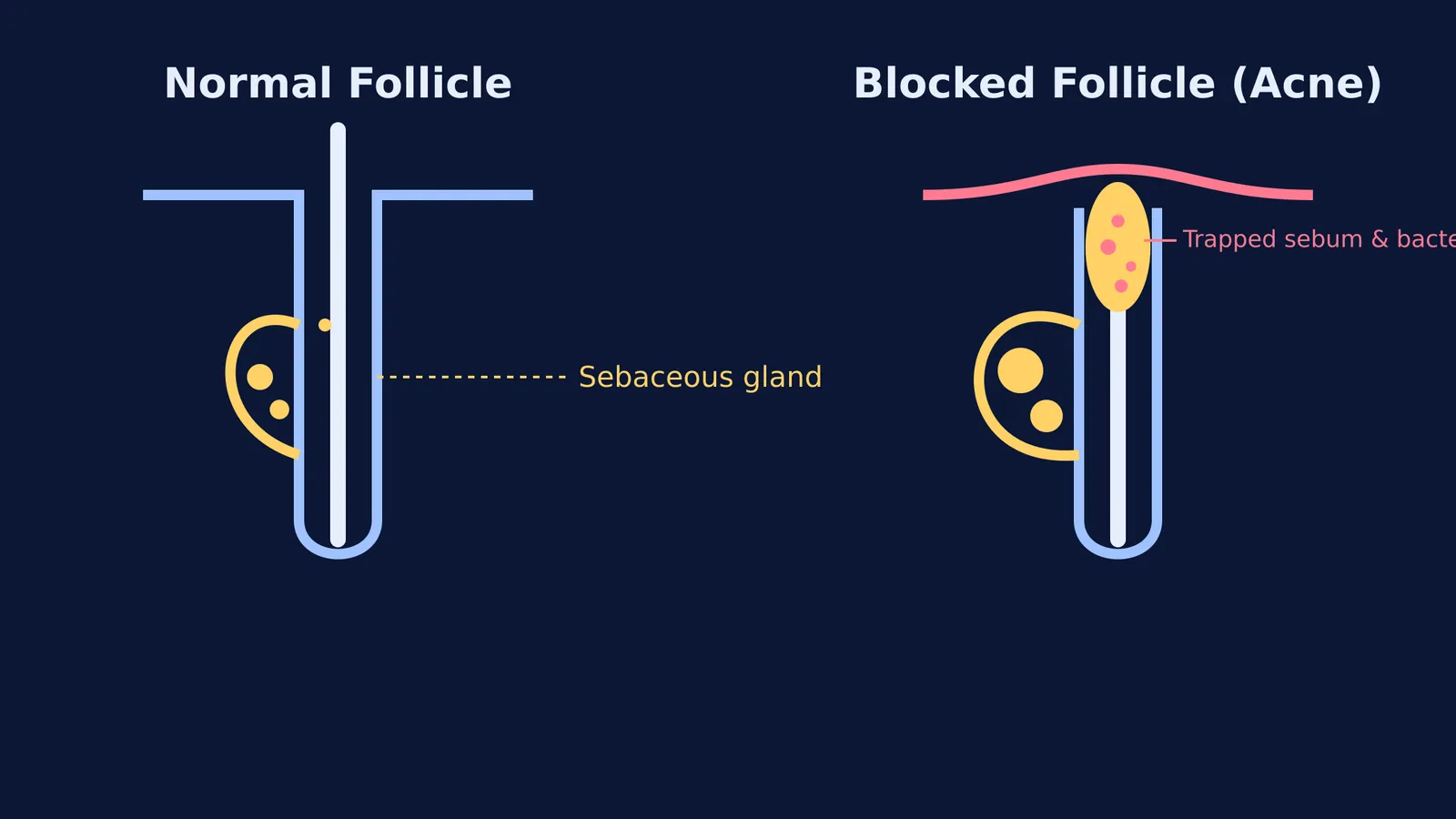 Diagram comparing a normal hair follicle and a blocked follicle with acne