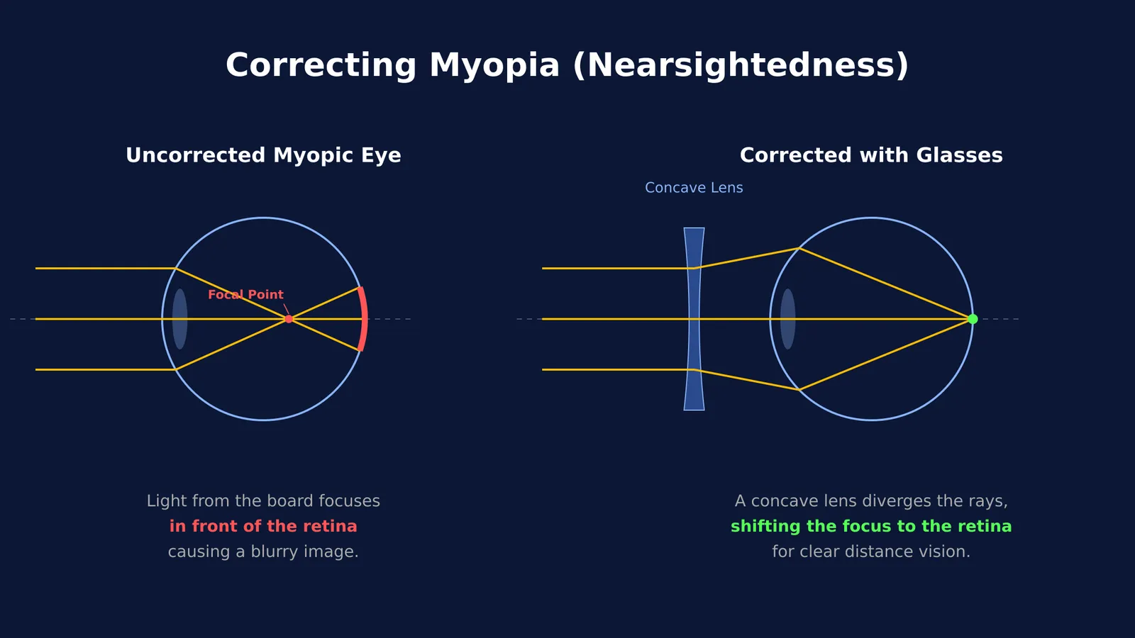 Diagram comparing an uncorrected myopic eye and an eye corrected with a concave lens.
