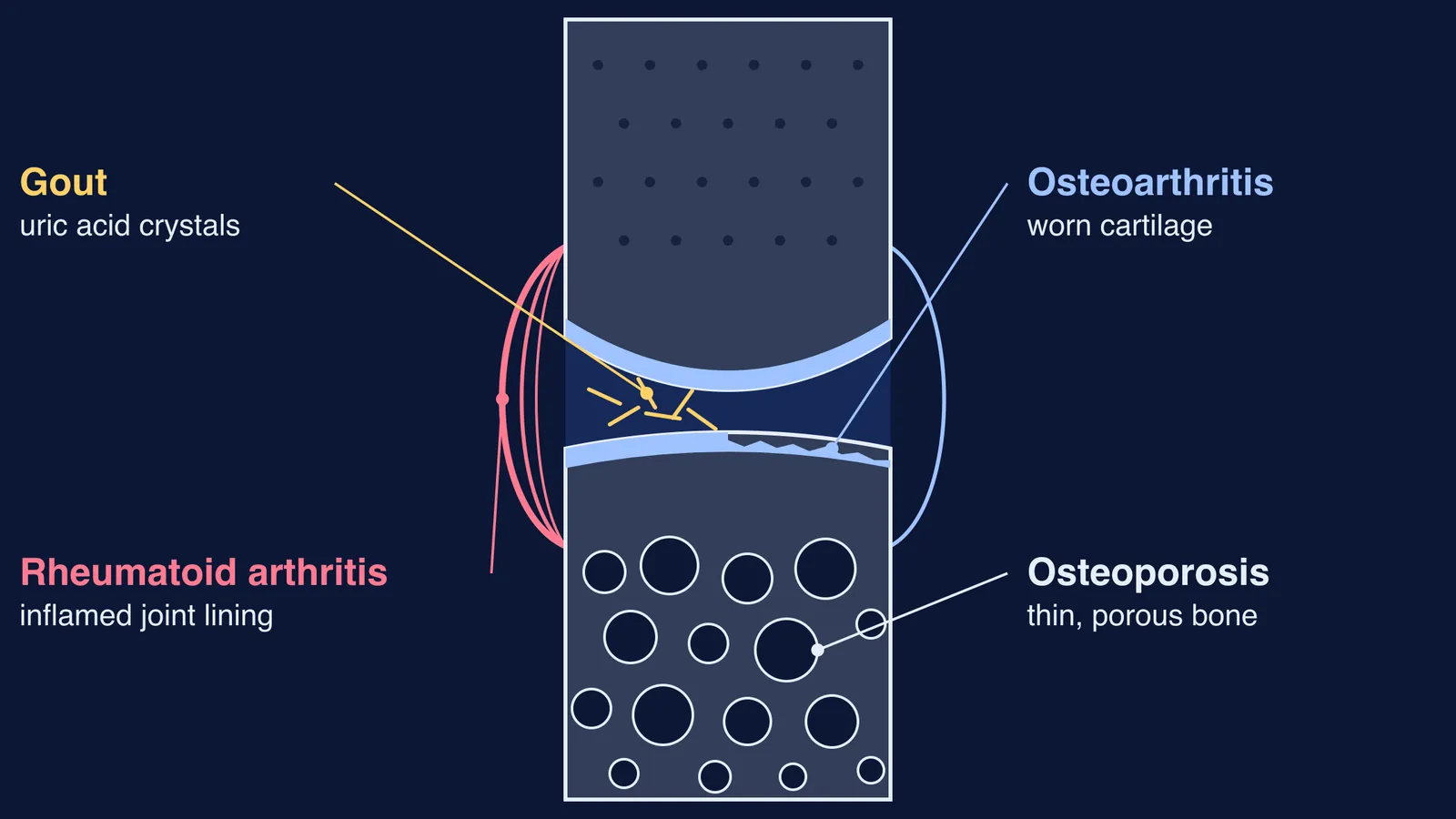 Diagram of a joint showing where gout, arthritis and osteoporosis cause damage