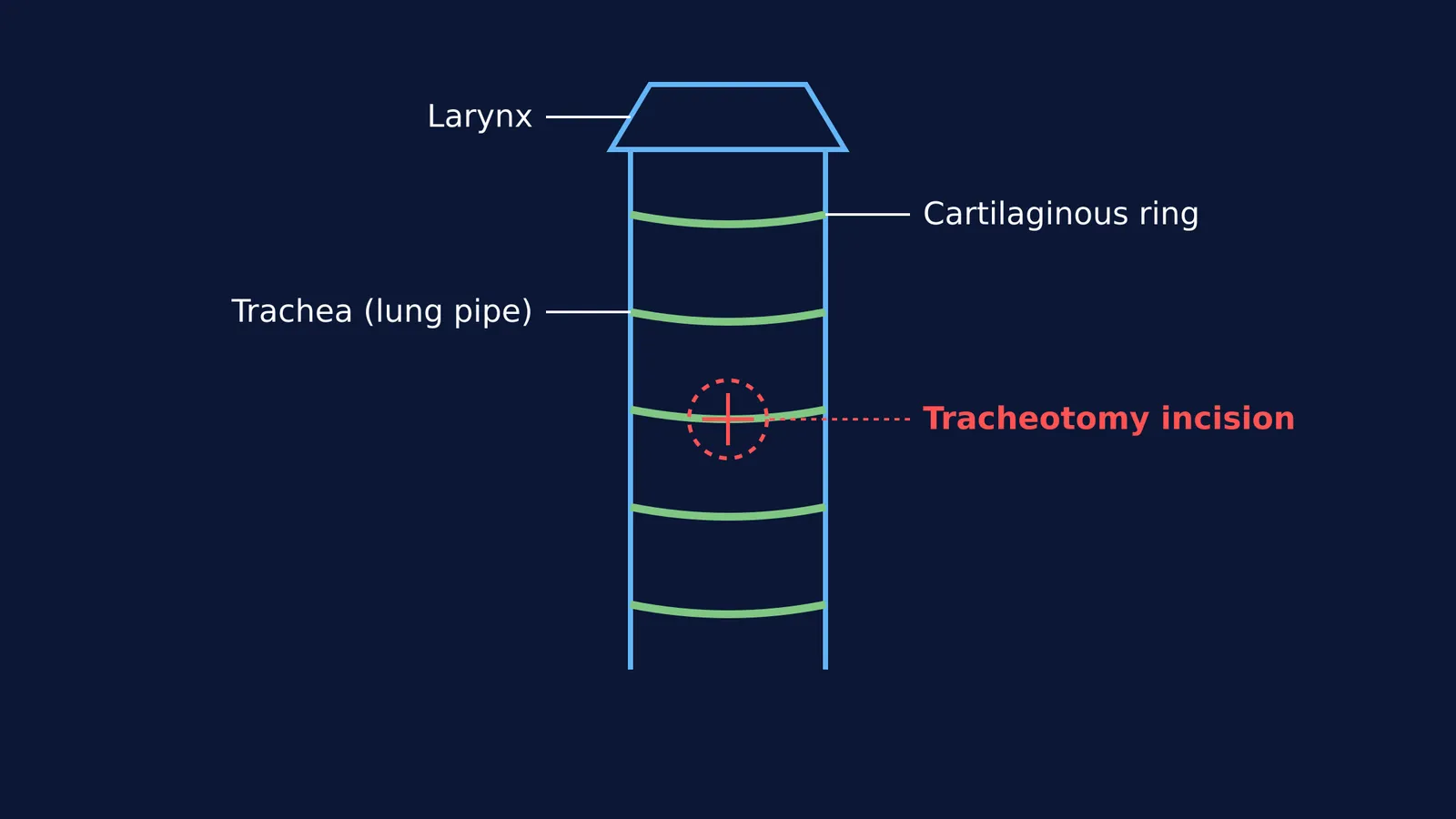 Diagram of a trachea showing the site of a tracheotomy incision