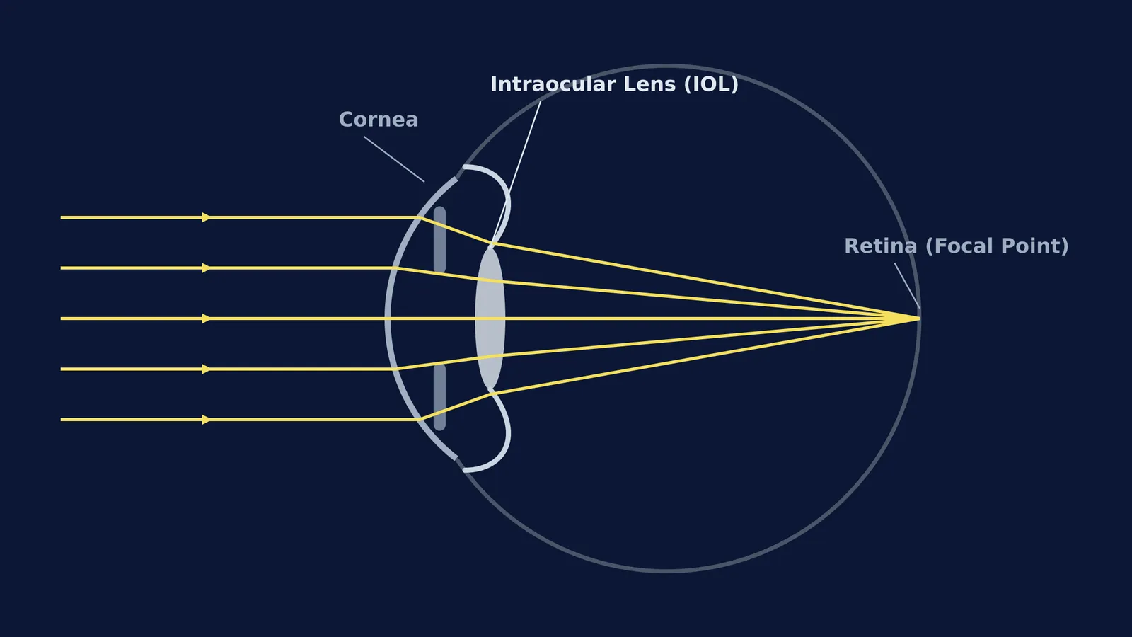 Diagram of an intraocular lens focusing light on the retina