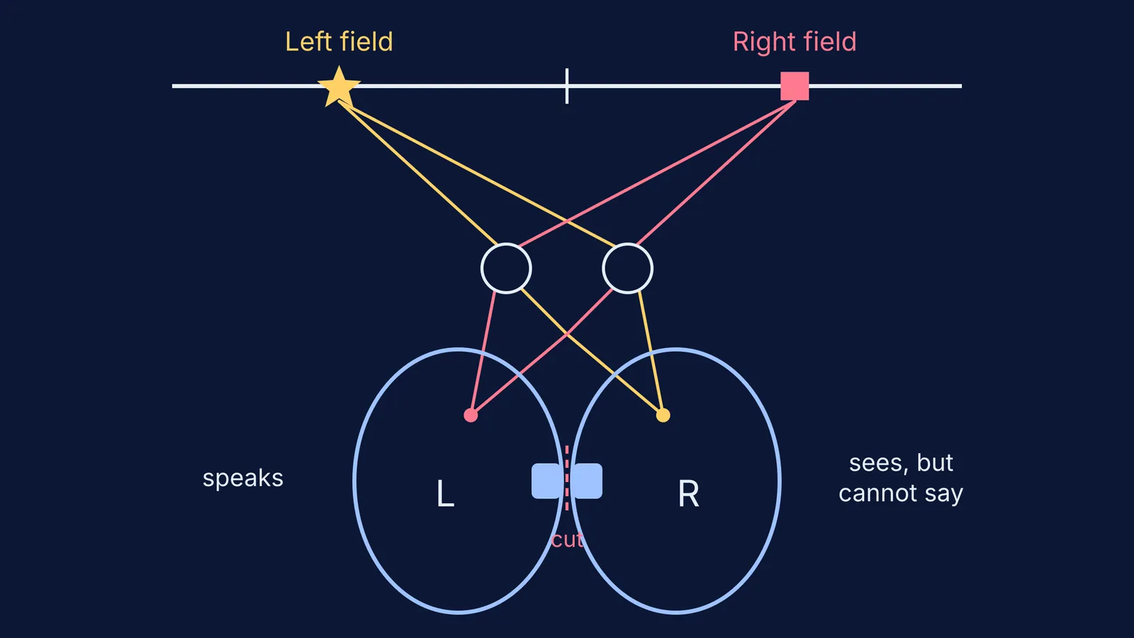 Diagram of visual fields wiring to opposite brain hemispheres with the bridge cut