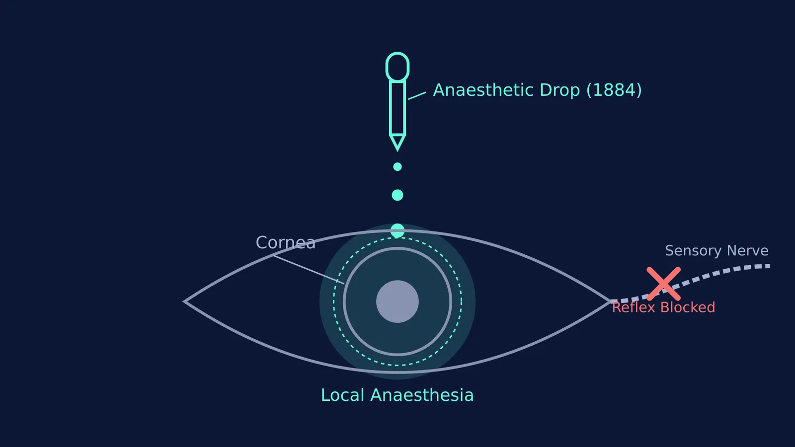 Diagram showing an anaesthetic drop on an eye blocking reflexes in the sensory nerve.