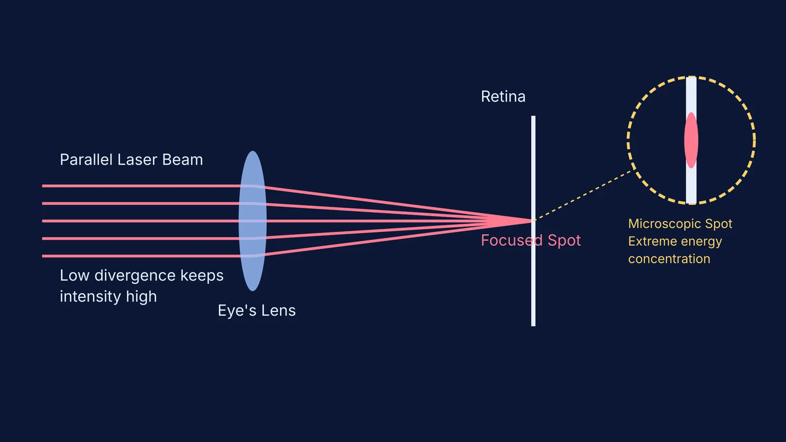 Diagram showing the eye focusing parallel laser rays to a microscopic spot on the retina