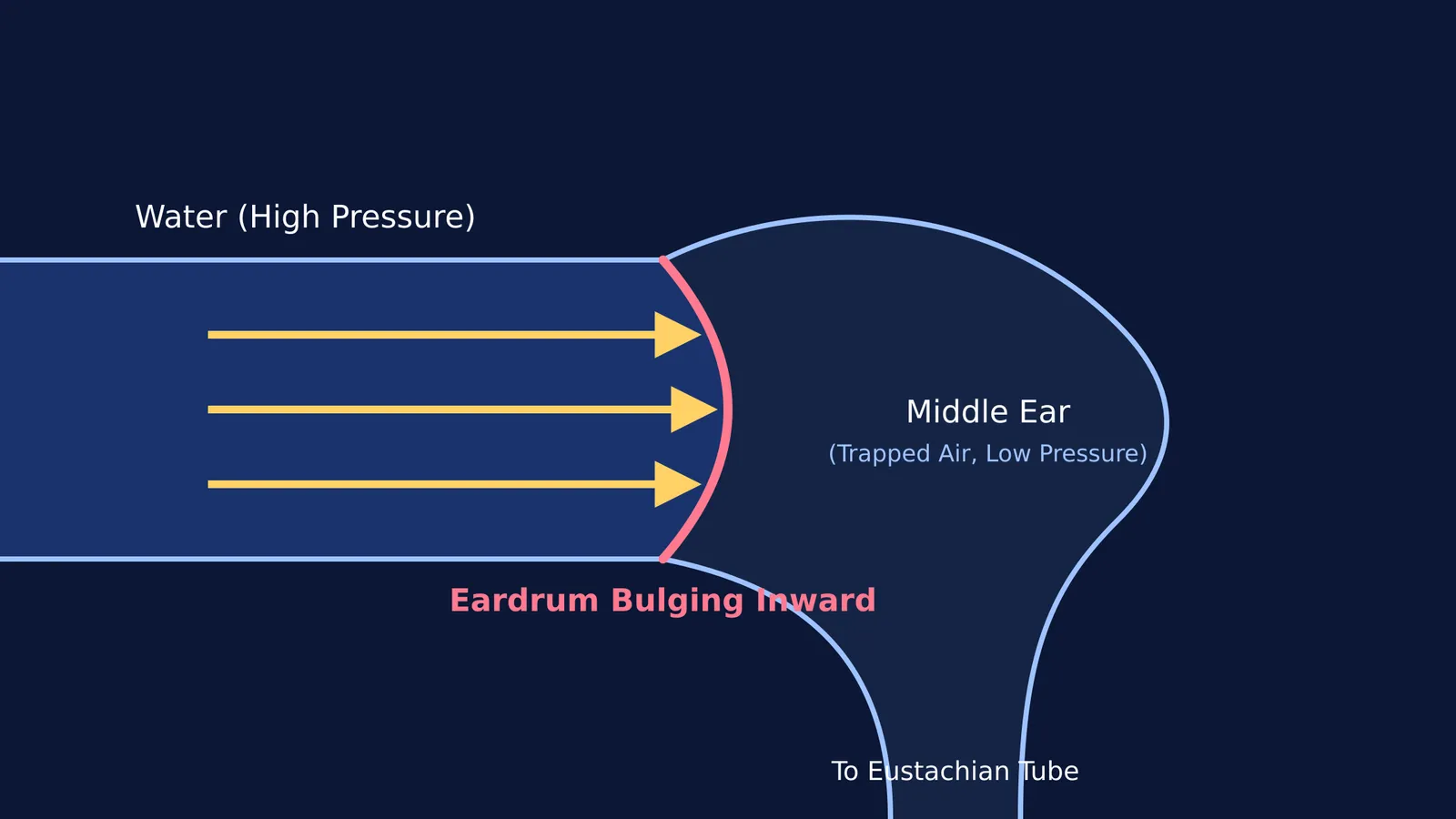 Diagram showing water pressure pushing the eardrum inward against middle ear air pressure.