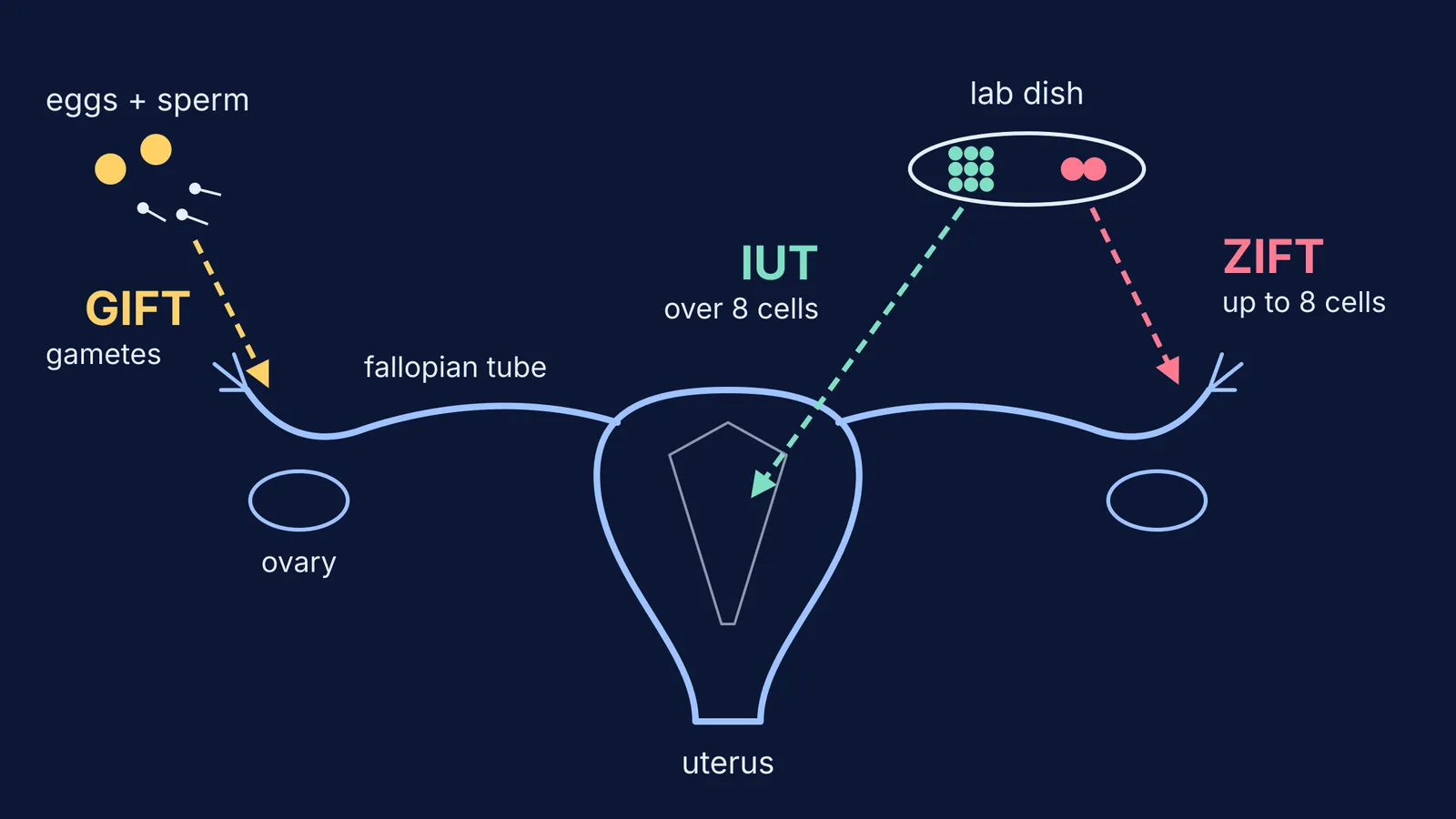 Diagram showing where GIFT, ZIFT and IUT place gametes or embryos