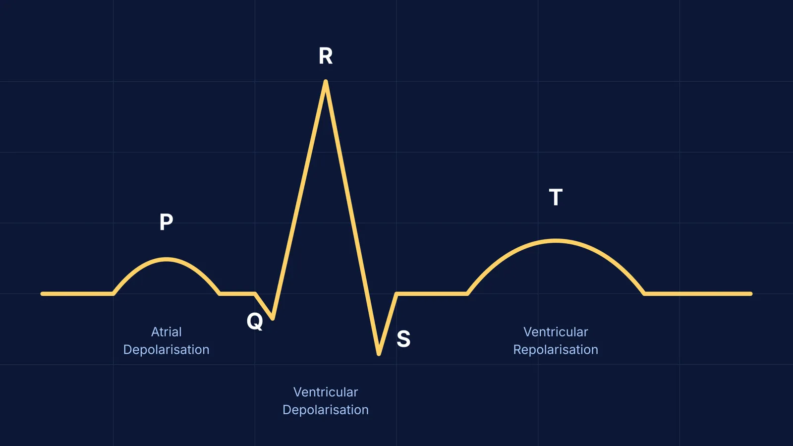 ECG trace matching P, QRS, T waves to cardiac electrical events.