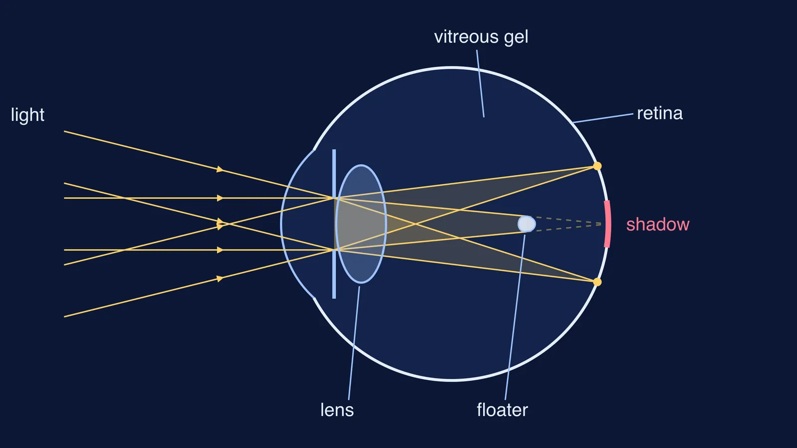 Eye cross-section: three light cones reach the retina, one blocked by a floater