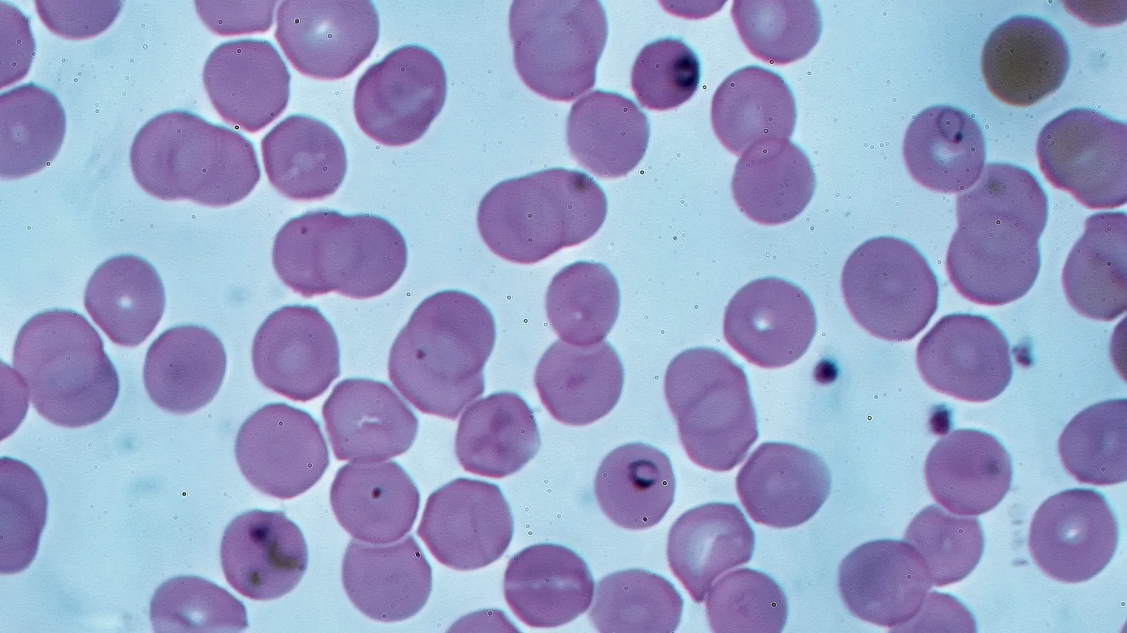 Giemsa-stained blood smear: pink-violet red cells, a few holding dark ring-form malaria parasites