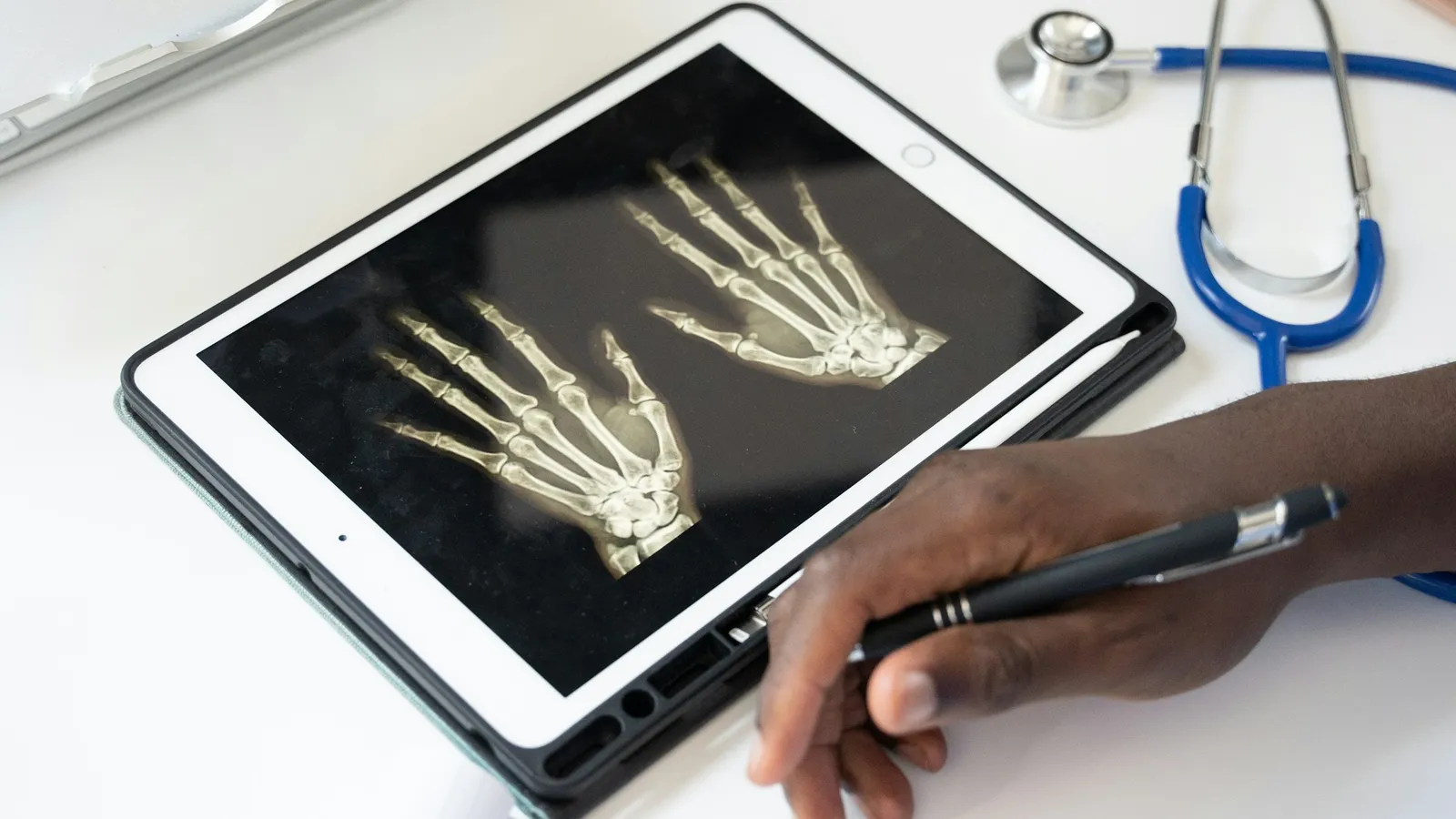 Hand X-rays shown on a tablet beside a stethoscope