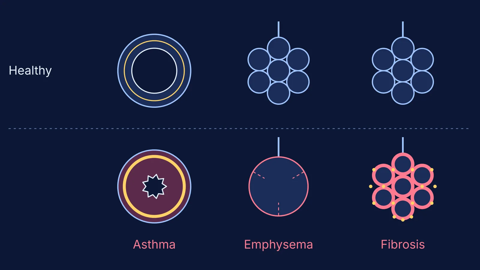 Healthy airway and alveoli compared with asthma, emphysema and dust fibrosis