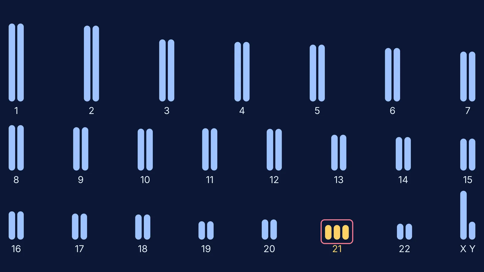 Karyogram of 47 chromosomes with three copies of chromosome 21 highlighted