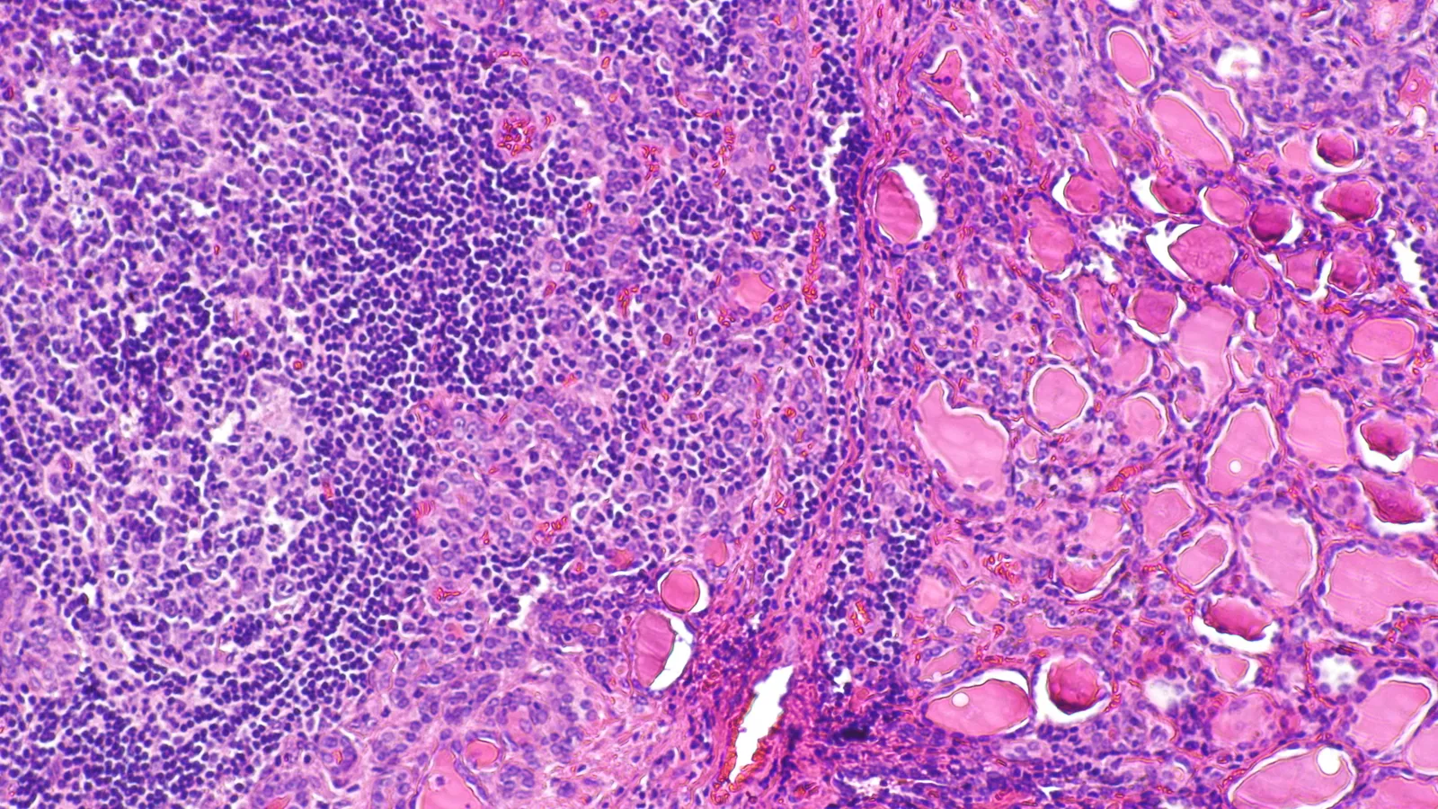 Micrograph of thyroid tissue crowded with dark-stained lymphocytes beside pink thyroid follicles