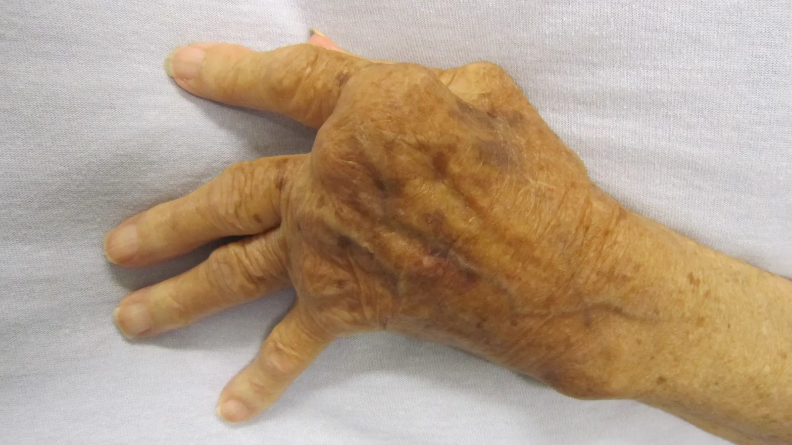Older person's hand with rheumatoid arthritis, fingers bent sideways at the knuckles