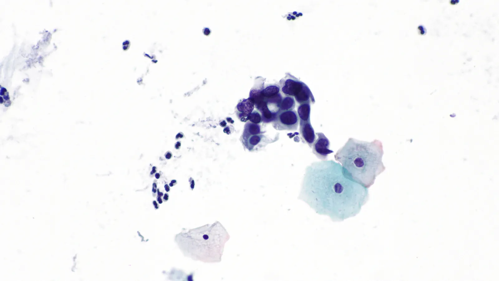 Pap smear micrograph: crowded cluster of dark abnormal cells beside pale normal cells