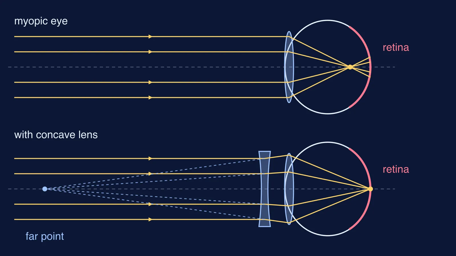 Ray diagram: myopic eye focuses short of retina; concave lens corrects it