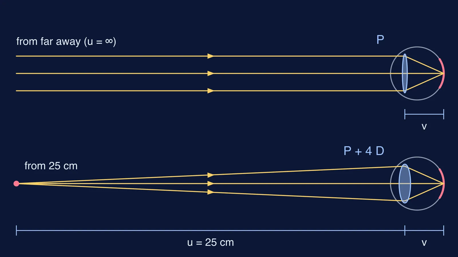 Ray diagrams of an eye focusing a distant object and one at 25 cm