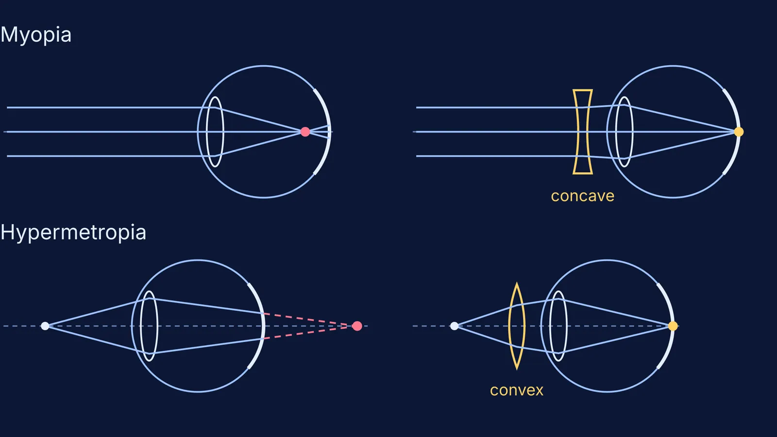 Ray diagrams of myopic and hypermetropic eyes, before and after correcting lenses