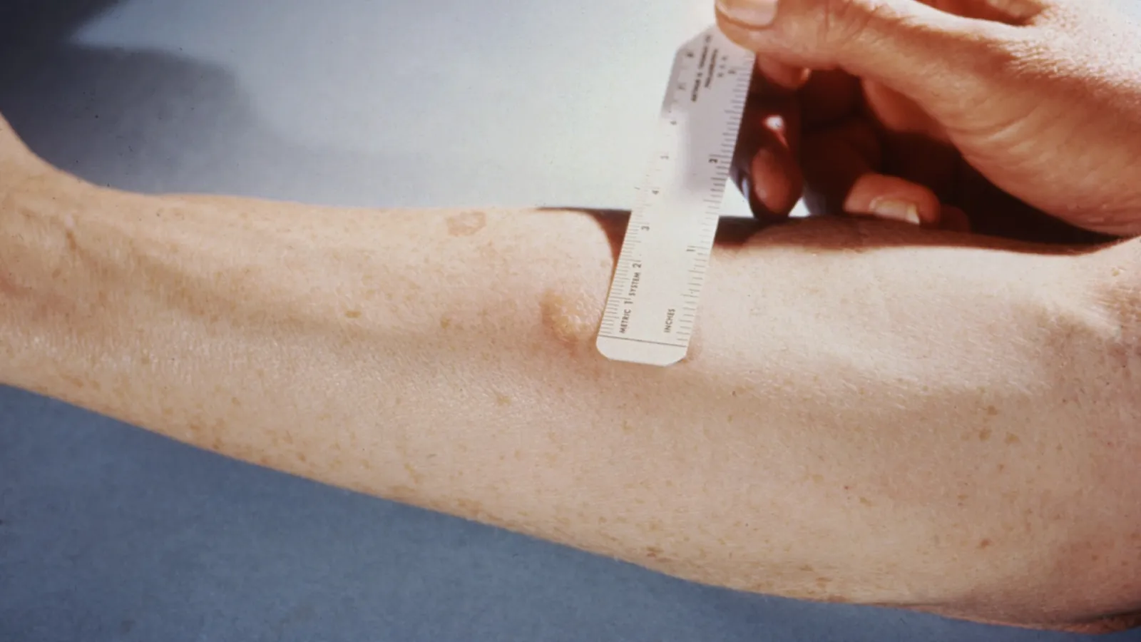 Ruler measuring the raised bump of a tuberculin skin test on a forearm