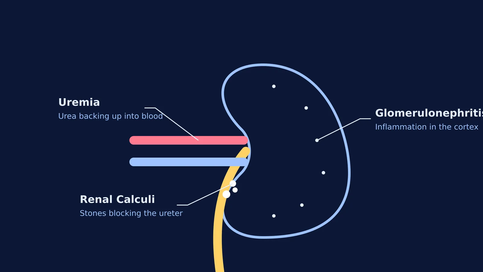 Schematic diagram showing where uremia, renal calculi, and glomerulonephritis affect the kidney.