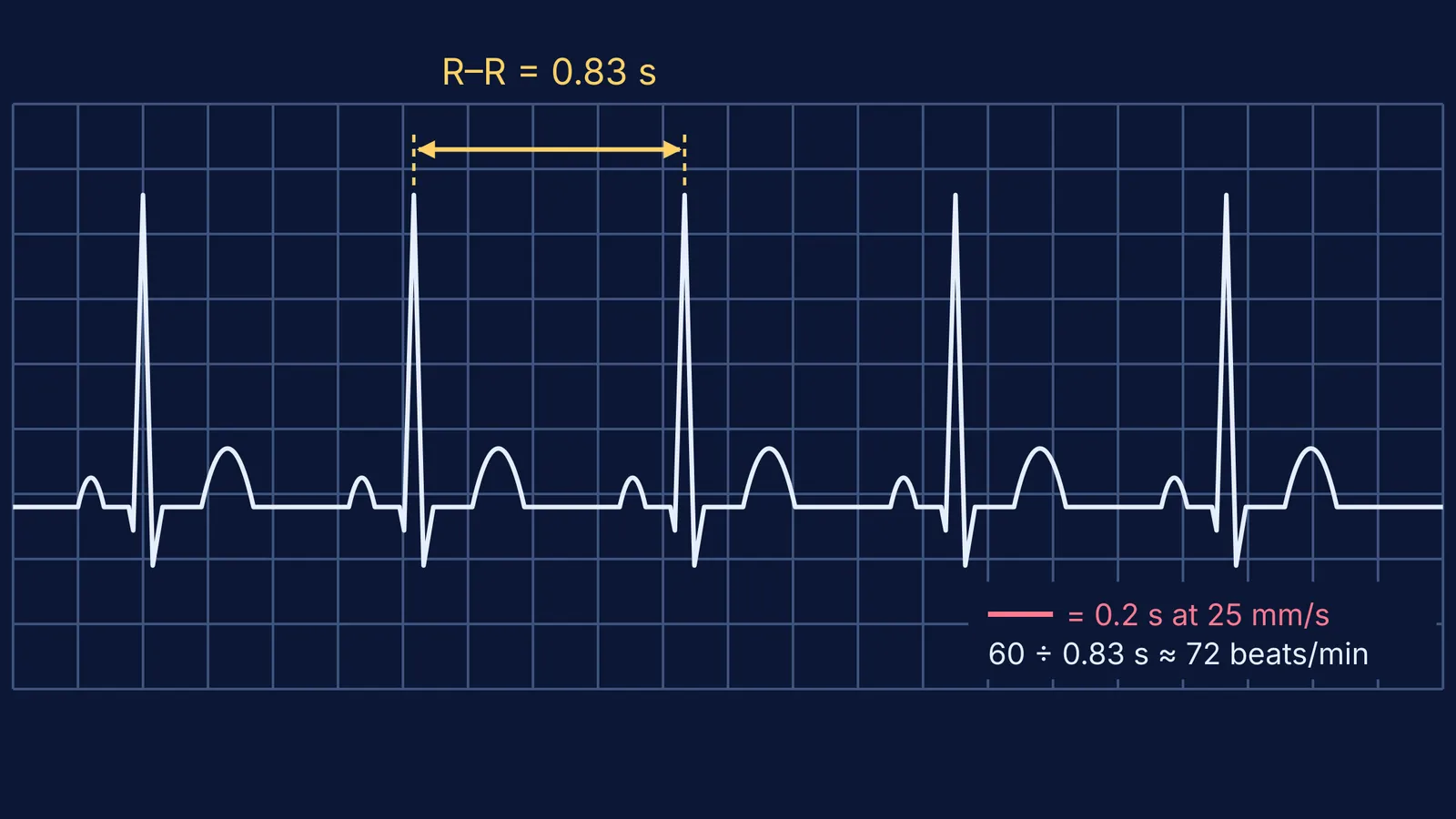 Schematic ECG trace on a grid with the R–R interval marked as 0.83 seconds