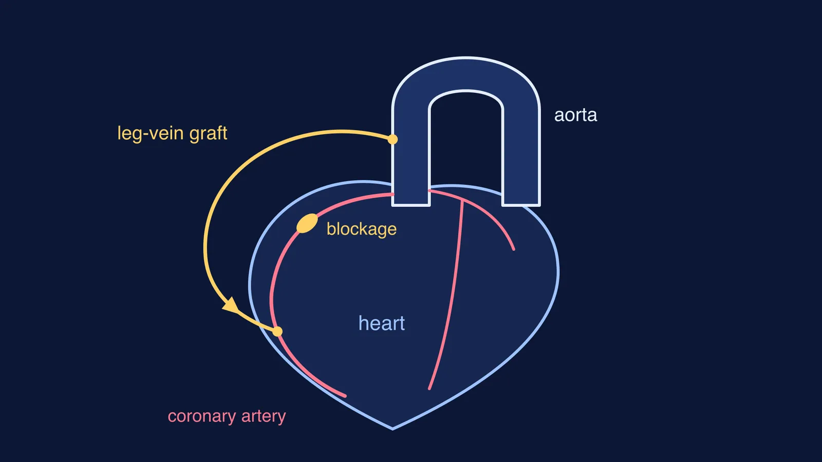 Schematic heart with a leg-vein graft from the aorta past a coronary blockage