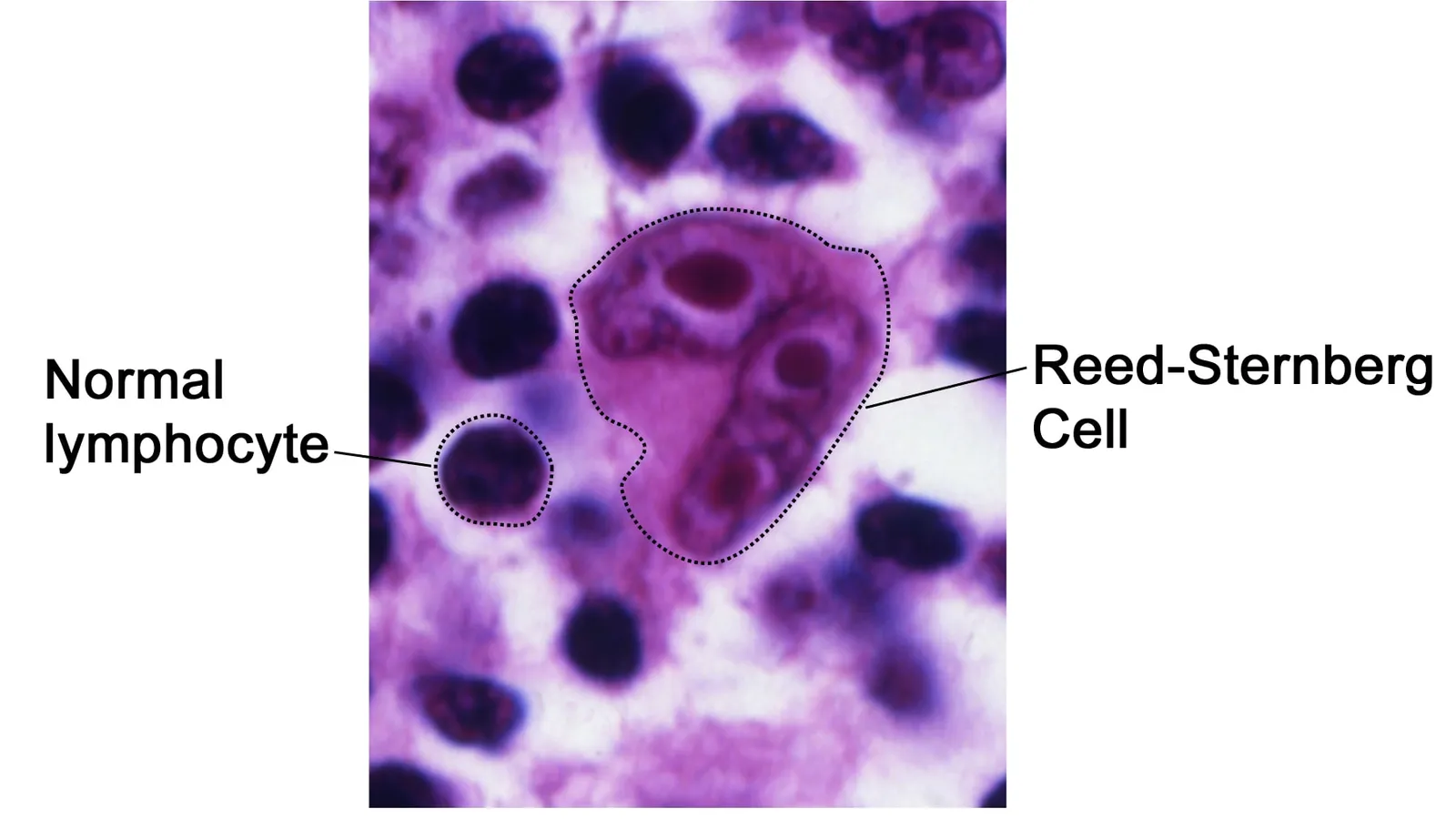 Stained micrograph labelling a large Reed-Sternberg cell beside a smaller normal lymphocyte